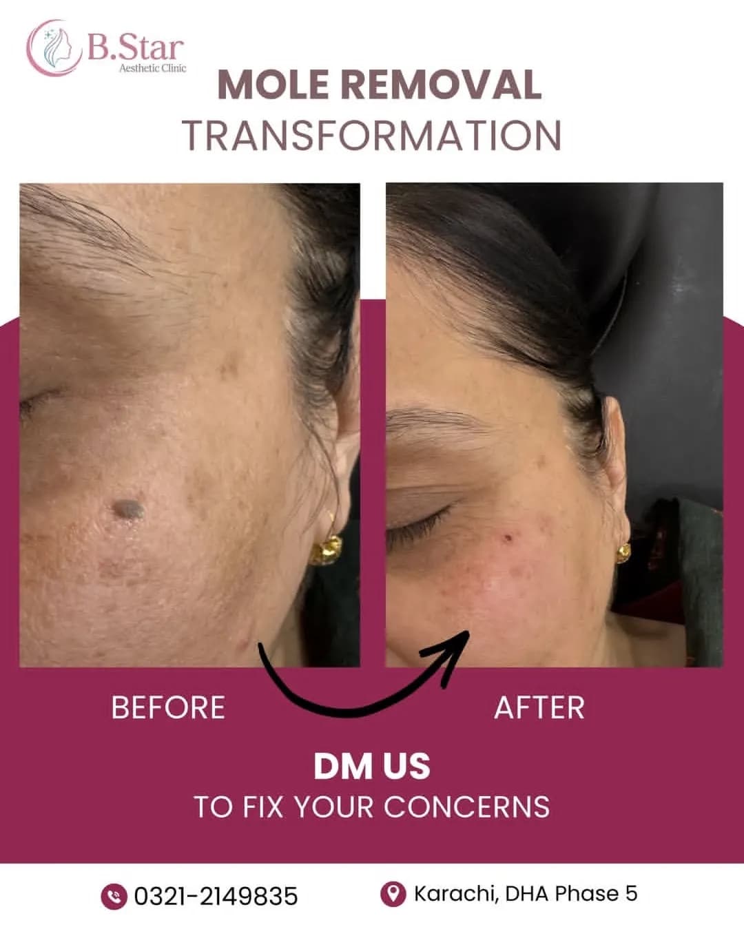 Mole removal before and after at B.Star Aesthetic Clinic