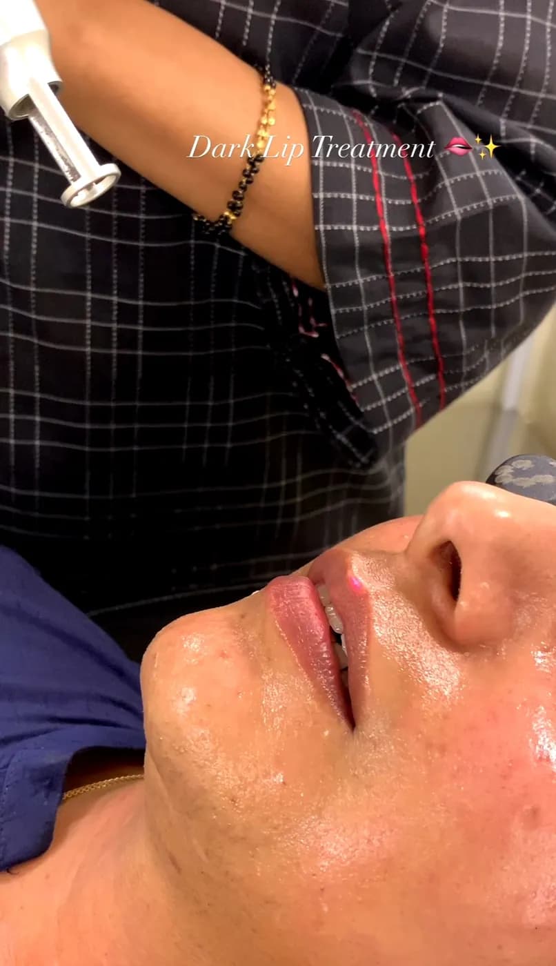 Laser treatment for dark lips
